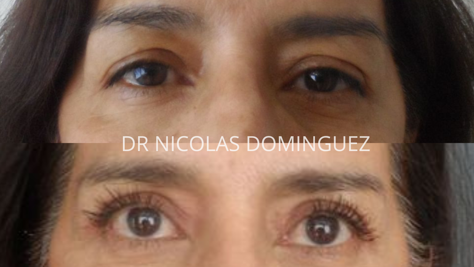blefaroplastía (2)