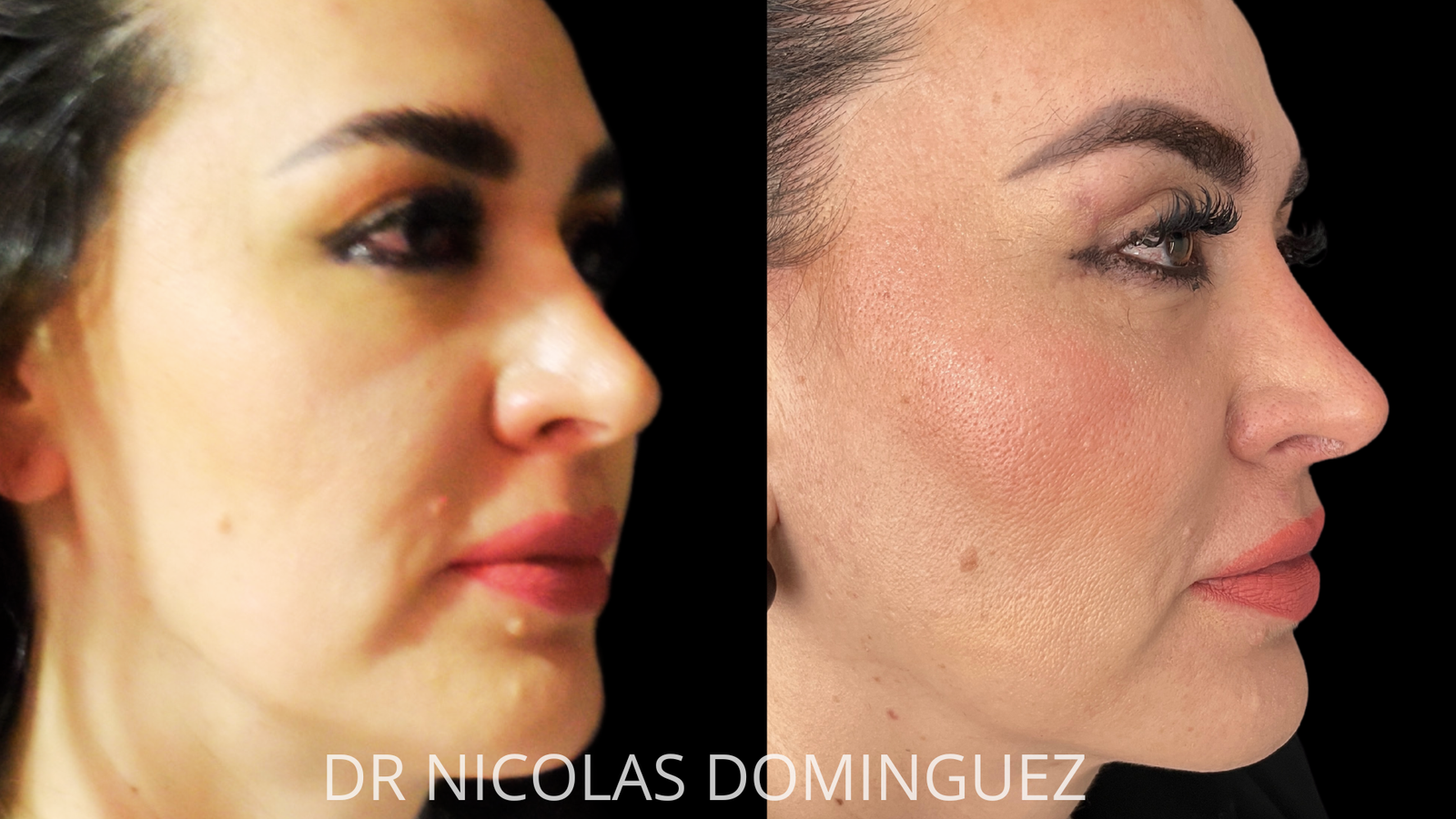 elevación de cejas
