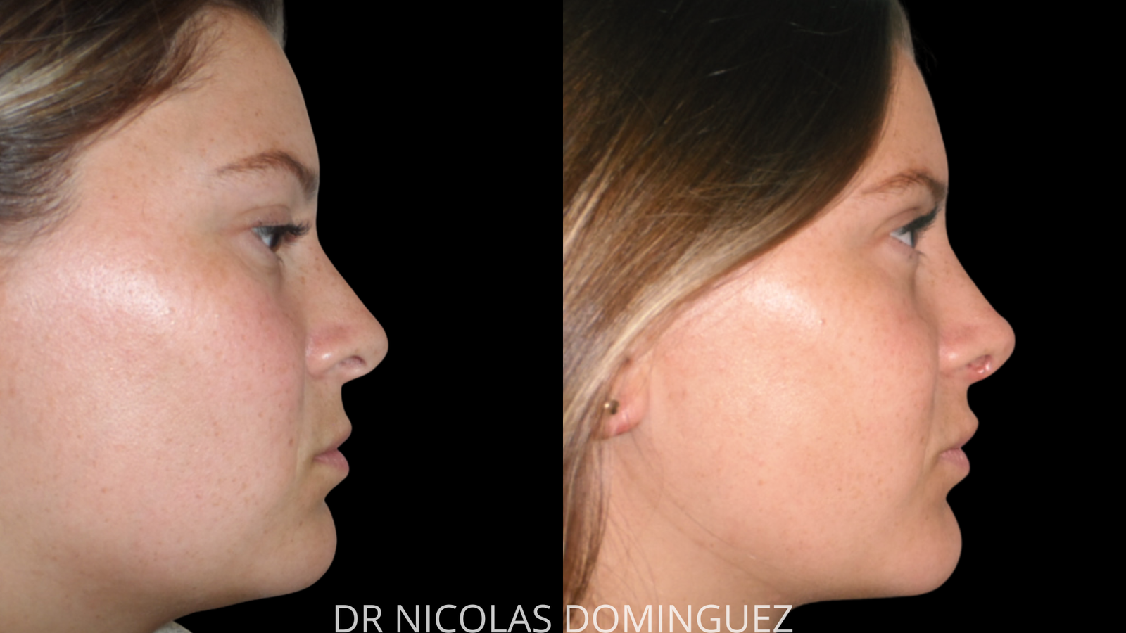 lipo de cuello