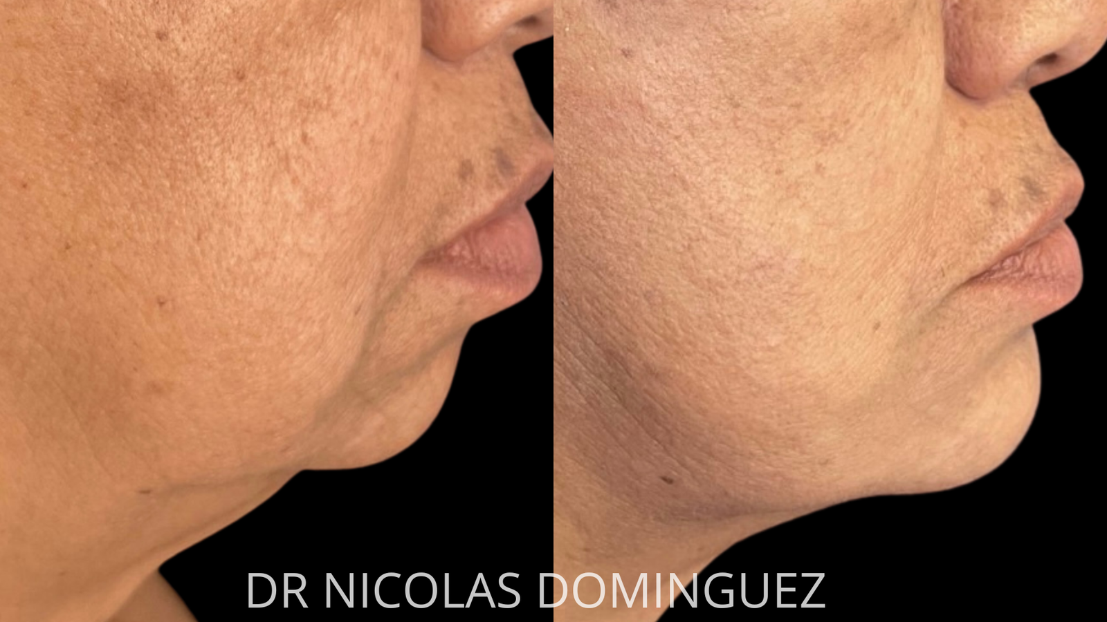mentoplastia (4)